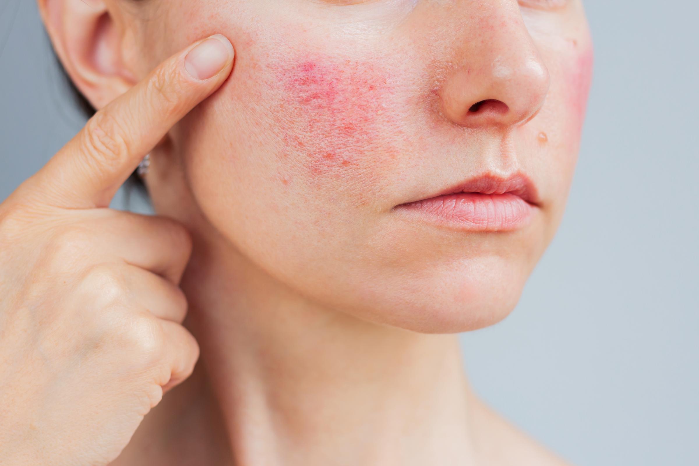 A young woman suffering from a skin breakout | Source: Getty Images